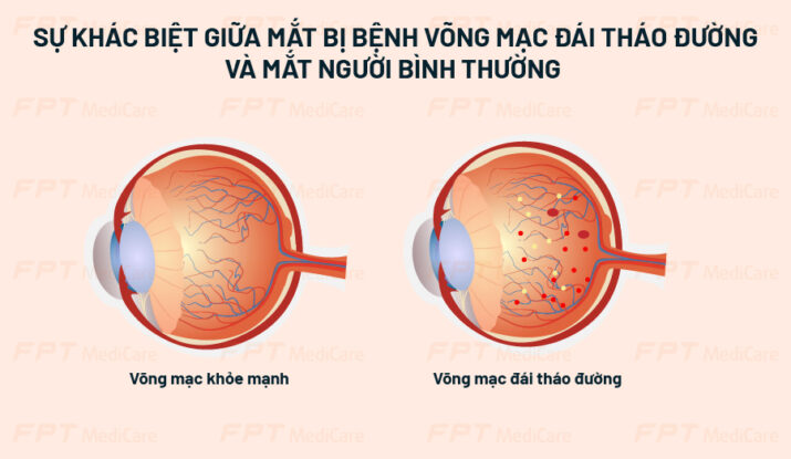 Sự khác biệt giữa mắt bị bệnh võng mạc đái tháo đường và mắt người bình thường