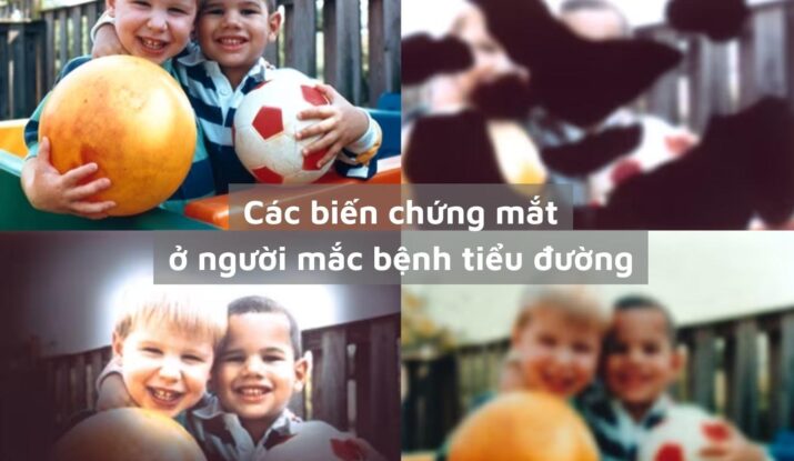 Các biến chứng mắt ở người mắc bệnh tiểu đường