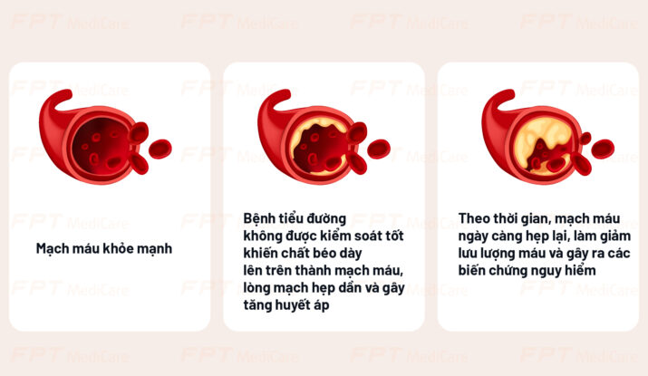 ảnh hưởng của đường huyết lên mạch máu