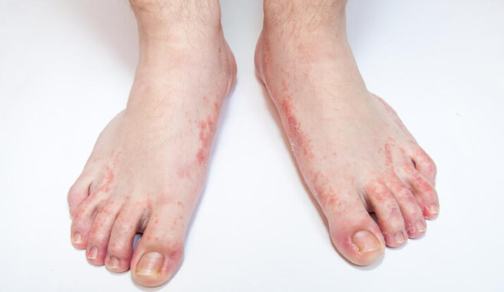 Nhiễm nấm bàn chân do đái tháo đường